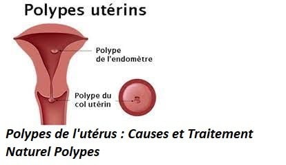 Comment Soigner Un Polype De L Ut Rus Traitement Naturel Polype De L