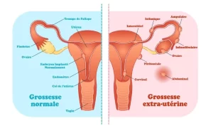 Quelles sont les différentes formes de l'annexite ?