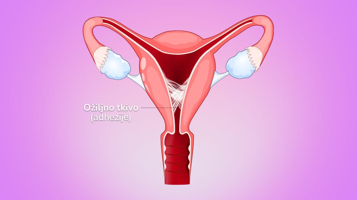 Synéchie Utérine traitement naturel