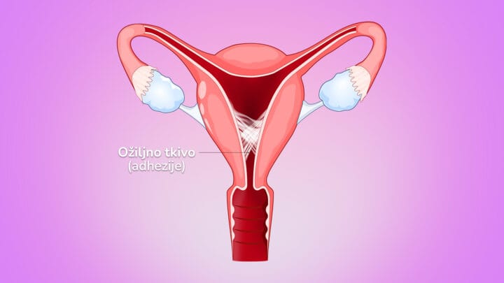 Synéchie Utérine traitement naturel