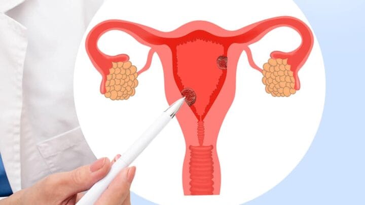 Traitement Naturel Polypes de l'utérus