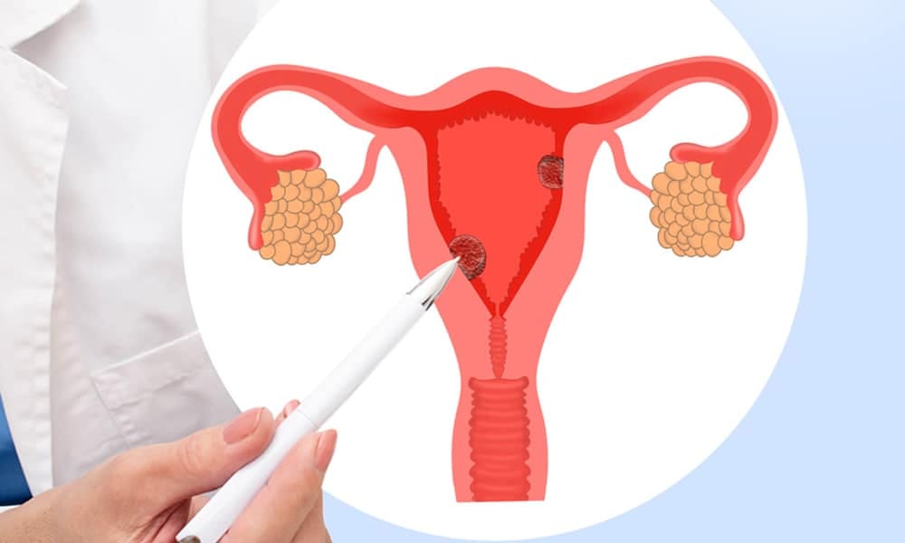 Traitement Naturel Polypes de l'utérus