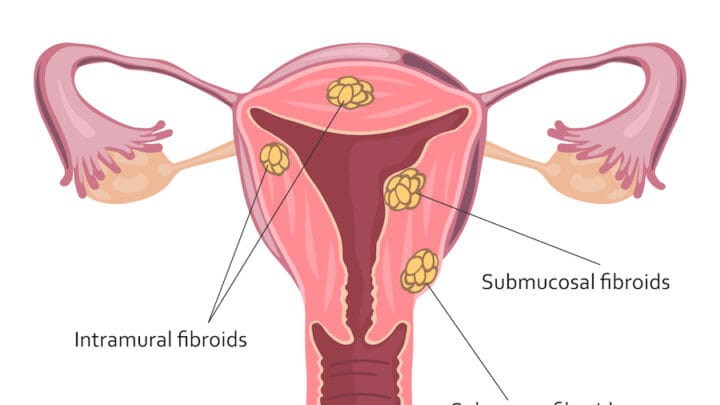 Traitement naturel fibrome