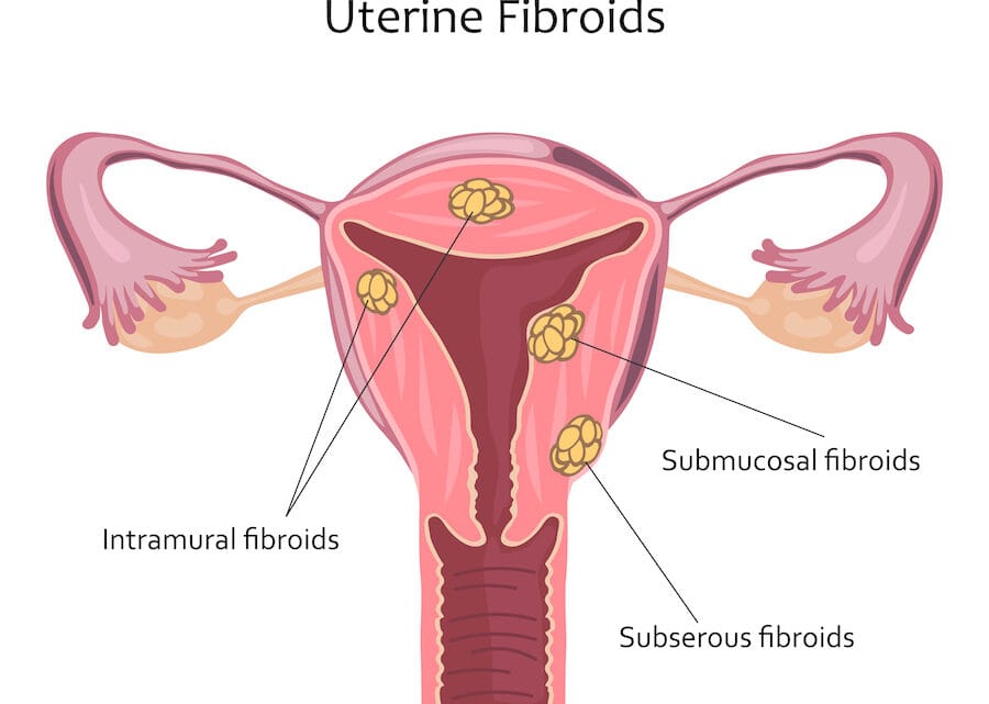 Traitement naturel fibrome