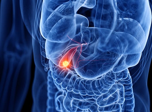 Solution naturelle cancer de la vésicule biliaire