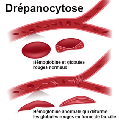 Soigner la drépanocytose naturellement