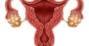 Alimentation et Kystes Ovariens