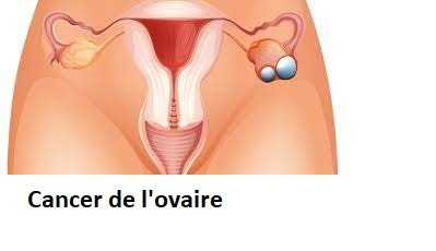 Qu'est-ce que le cancer de l'ovaire?