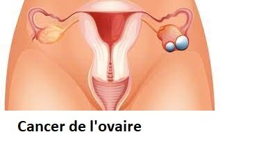 cancer de l'ovaire solution naturelle