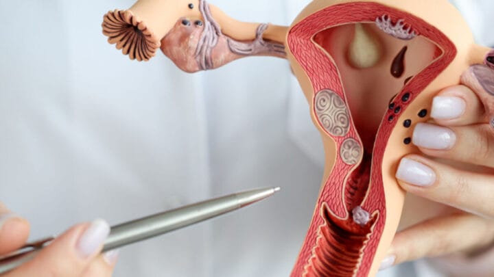 Traitement Naturel des Kystes Ovariens