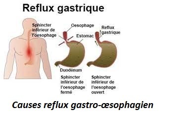 Reflux gastro-œsophagien traitement naturel