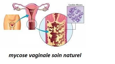 C'est quoi une mycose vaginale