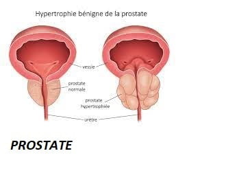 Solution pour soigner la Prostate
