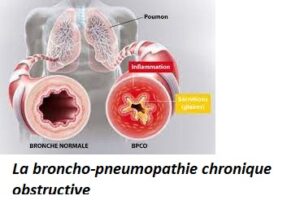 La Broncho-pneumopathie Chronique Obstructive Découvrez