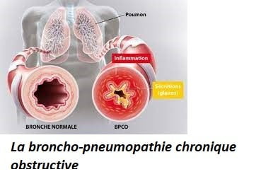 La broncho-pneumopathie chronique obstructive