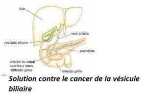 Solution contre le cancer de la vésicule biliaire