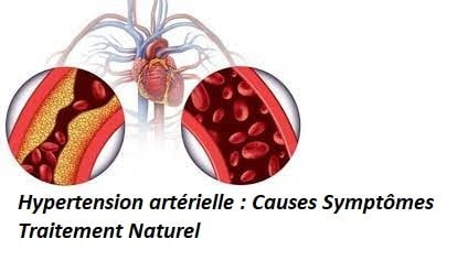 Hypertension artérielle : Causes Symptômes Traitement Naturel