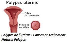 Soigner un polype utérin