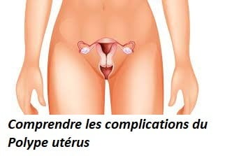 Endométriose Recette naturelle