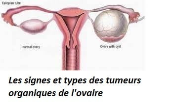 Les signes et types des tumeurs organiques de l'ovaire