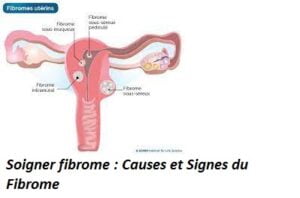 Soigner fibrome : Causes et Signes du Fibrome