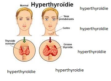hyperthyroïdie