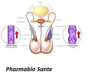 Chirurgie de la varicocèle: récupération et soutien naturel
