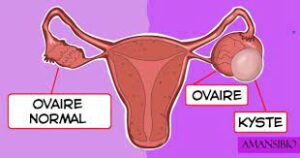 Belgique : Meilleur méthode pour faire disparaitre Kyste ovarien