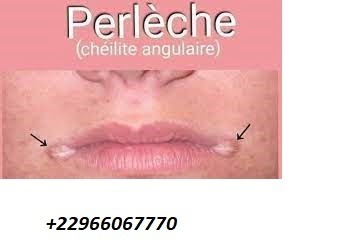 Solution pour éliminer la perlèche
