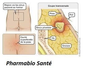 kyste pilonidal traitement sans opération