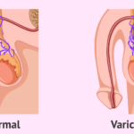 spermogramme après traitement varicocèle