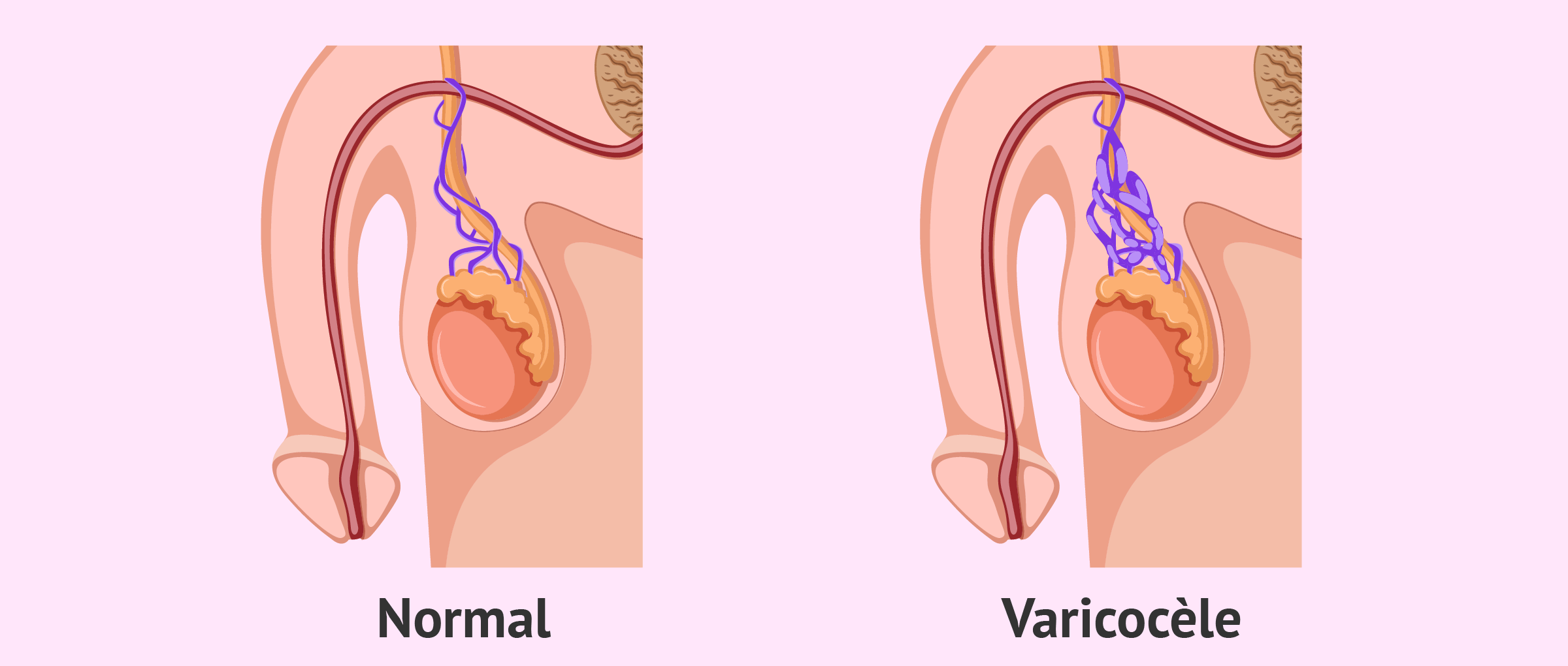 spermogramme après traitement varicocèle