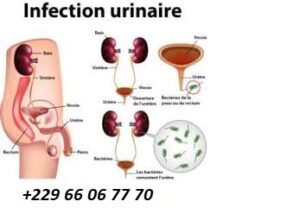 Comment traiter la cystite
