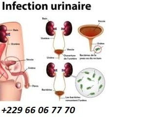 Comment traiter la cystite