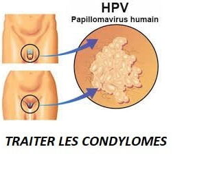 Condylome Traitement Naturel Condylome