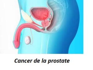 Soigner le cancer de la prostate