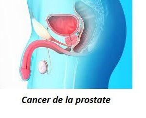 Soigner le cancer de la prostate