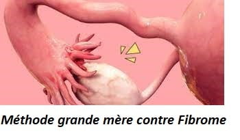 Méthode grande mère contre Fibrome