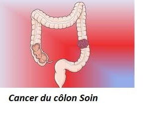 Cancer du côlon Soin
