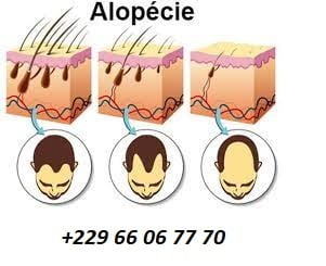 Quel traitement pour l'alopécie ?