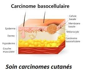 Soin carcinomes cutanés