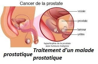 Traitement d'un malade prostatique