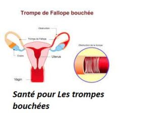 Traitement Naturel des Trompes de Fallope