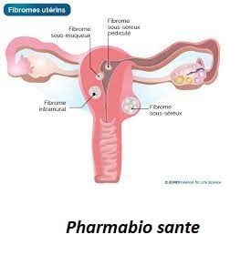 Fibromes Utérins Élimination Naturelle