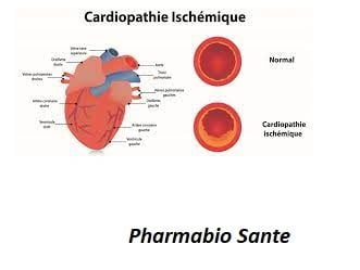 Soigner naturellement Cardiopathie ischémique