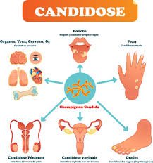 TRAITER LA CANDIDOSE NATURELLEMENT