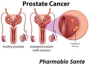 Comment soigner adénome de la prostate