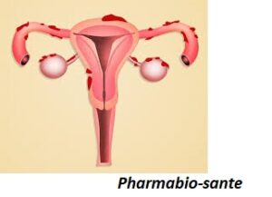 Soigner Fibromes avec l’Argile
