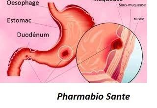 Recettes contre l'ulcère gastrique