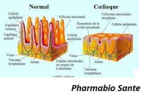 Qu'est-ce que la maladie coeliaque ?